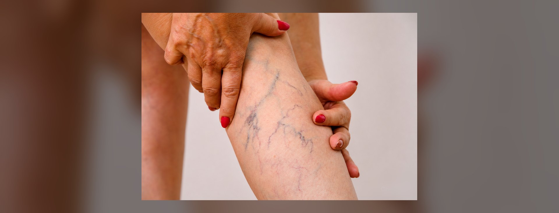 Varizes nas pernas — veias dilatadas e tortuosas